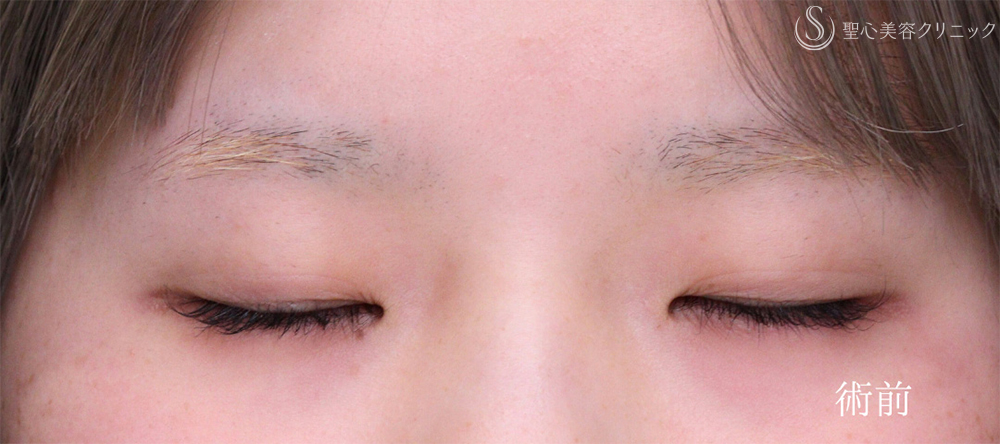 【10代女性・埋没法でナチュラル二重に】 二重術（埋没法）：マイクロメソッド+α（1ヶ月後） Before 