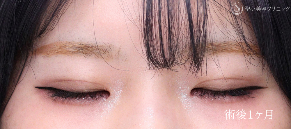 【10代女性・埋没法でナチュラル二重に】 二重術（埋没法）：マイクロメソッド+α（1ヶ月後） After 