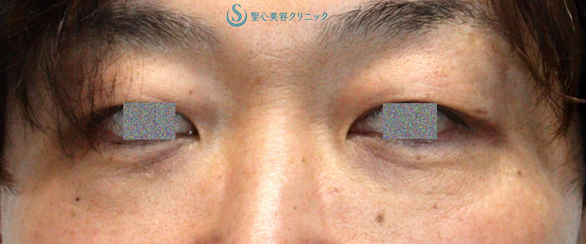 【40代男性・目の下のクマ（膨らみ）の改善】目の下の脂肪取り（経結膜下脱脂法）（1ヶ月後） After 