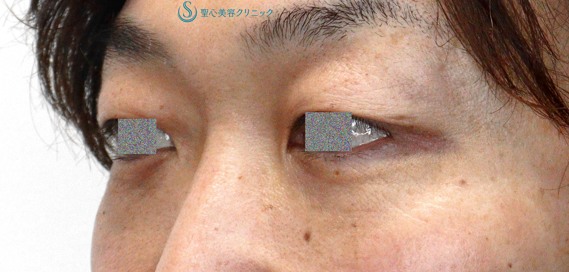 【40代男性・目の下のクマ（膨らみ）の改善】目の下の脂肪取り（経結膜下脱脂法）（1ヶ月後） After 
