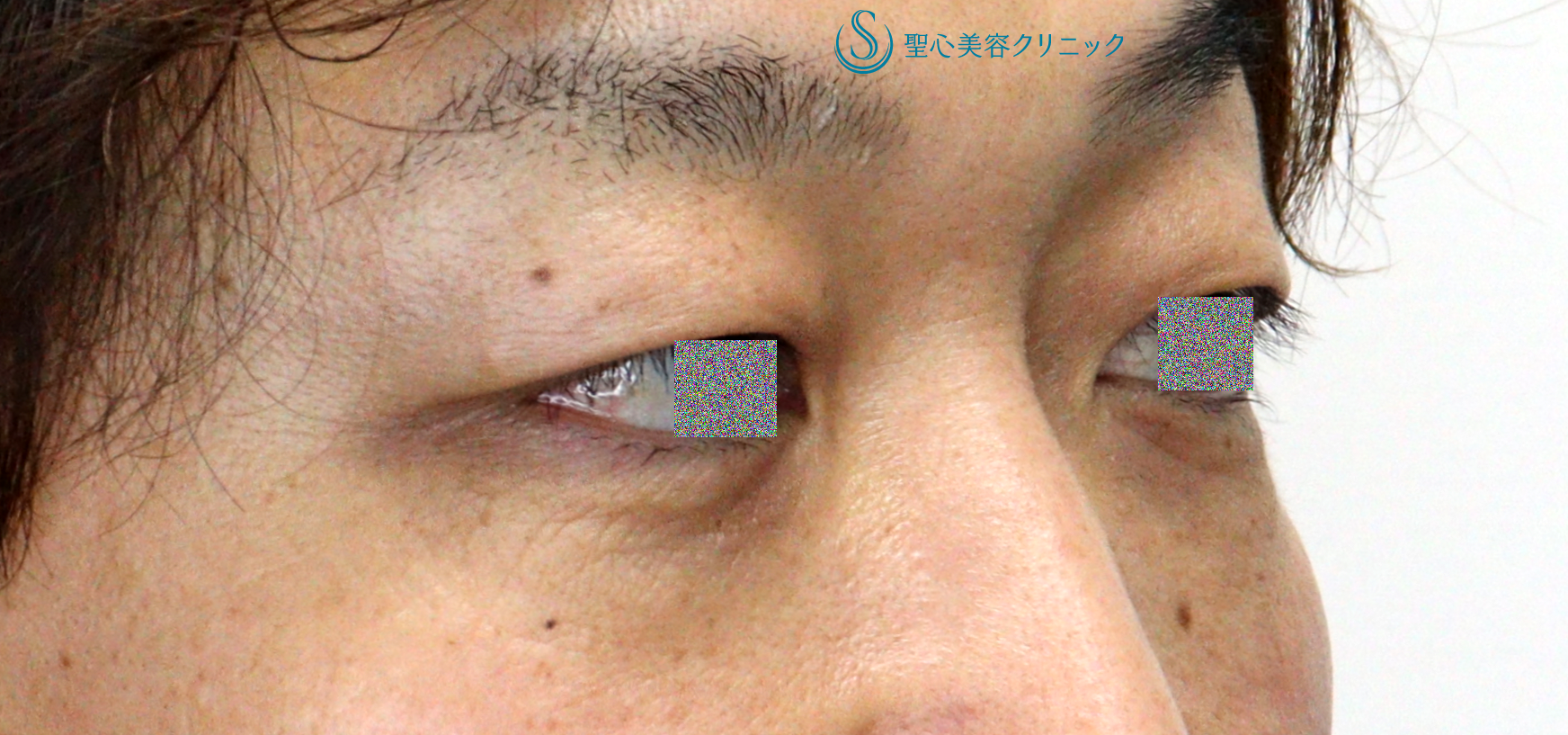 【40代男性・目の下のクマ（膨らみ）の改善】目の下の脂肪取り（経結膜下脱脂法）（1ヶ月後） After 