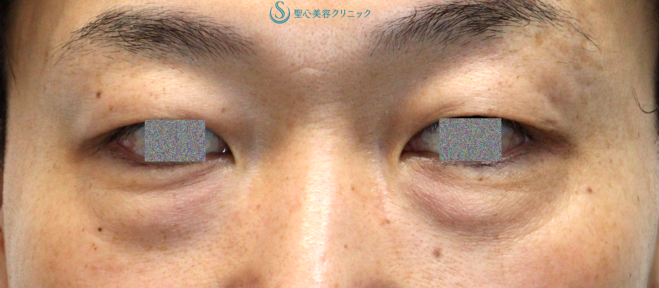 【40代男性・目の下のクマ（膨らみ）の改善】目の下の脂肪取り（経結膜下脱脂法）（1ヶ月後） Before 