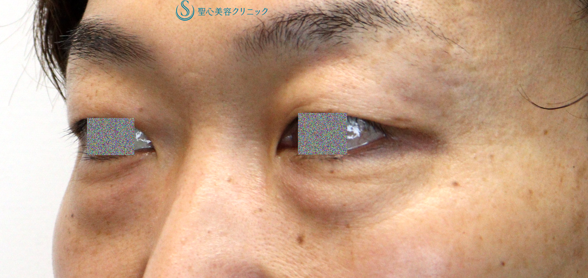 【40代男性・目の下のクマ（膨らみ）の改善】目の下の脂肪取り（経結膜下脱脂法）（1ヶ月後） Before 
