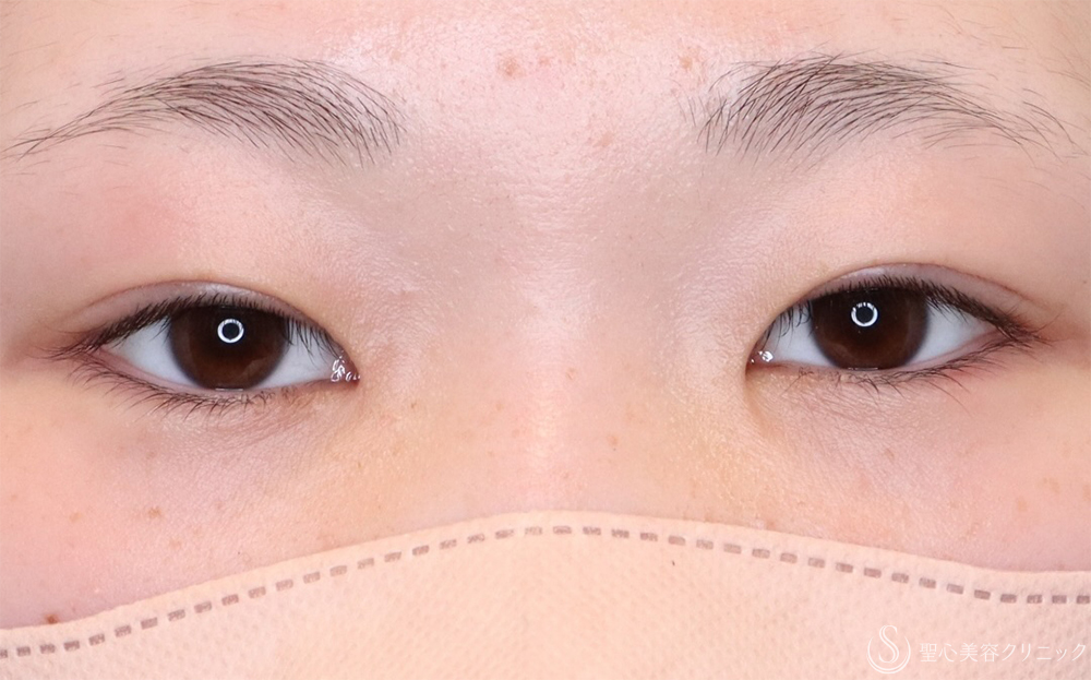 【10代女性・自然な二重に】二重全切開法（6ヶ月後） After 