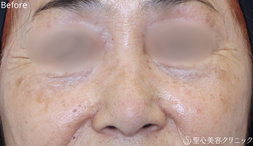 【70代女性・鼻を自然に小さく】小鼻縮小＋鼻尖縮小（耳介軟骨）＋Gメッシュ3本（1週間後） Before 
