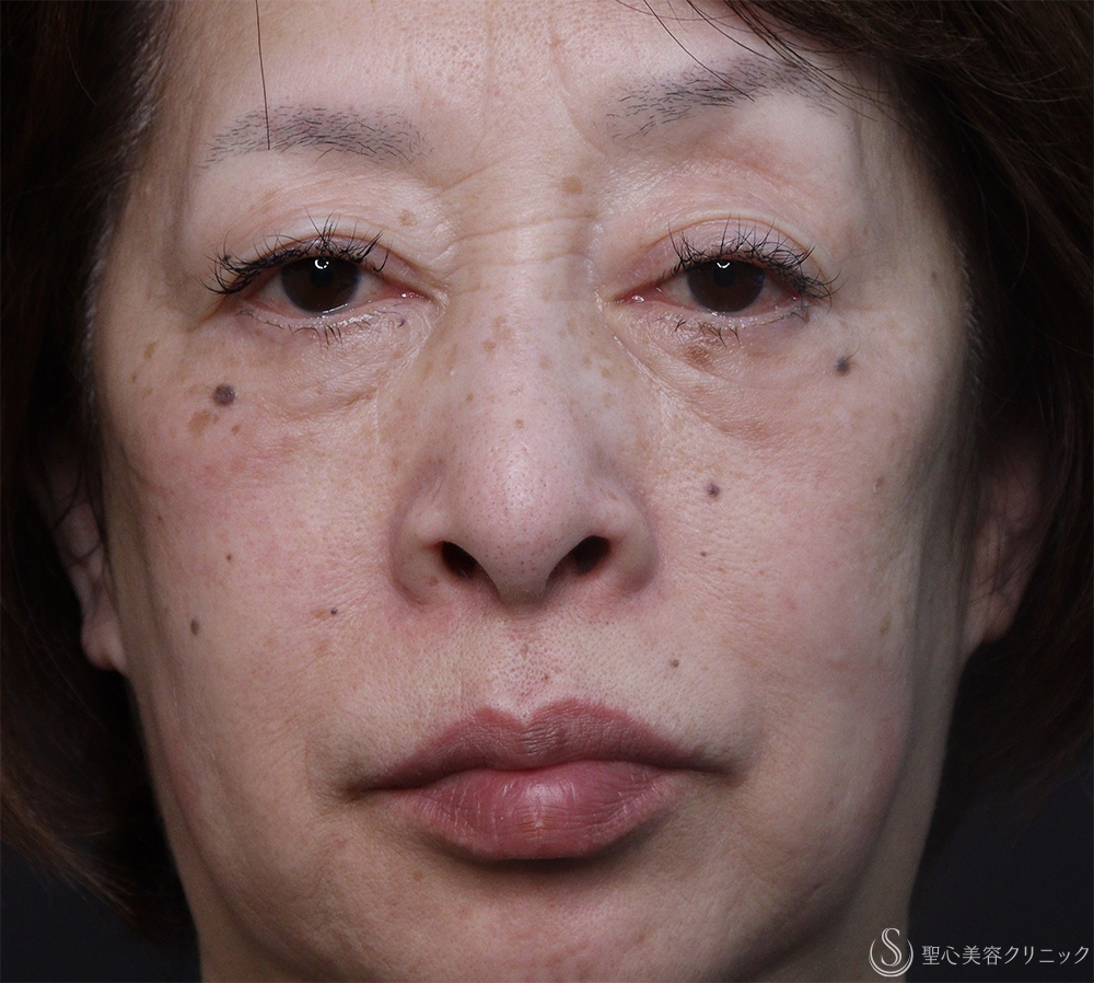 【60代女性・鼻孔を目立たなく】小鼻縮小（1ヶ月後） Before 