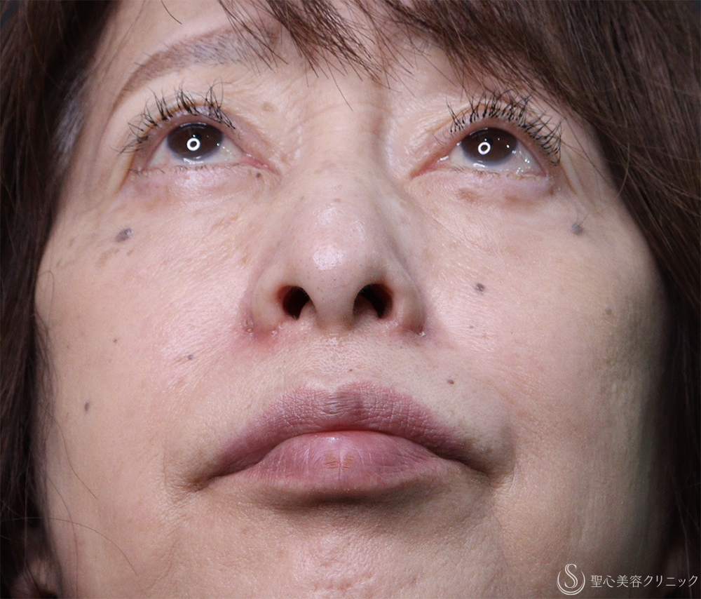 【60代女性・鼻孔を目立たなく】小鼻縮小（1ヶ月後） After 