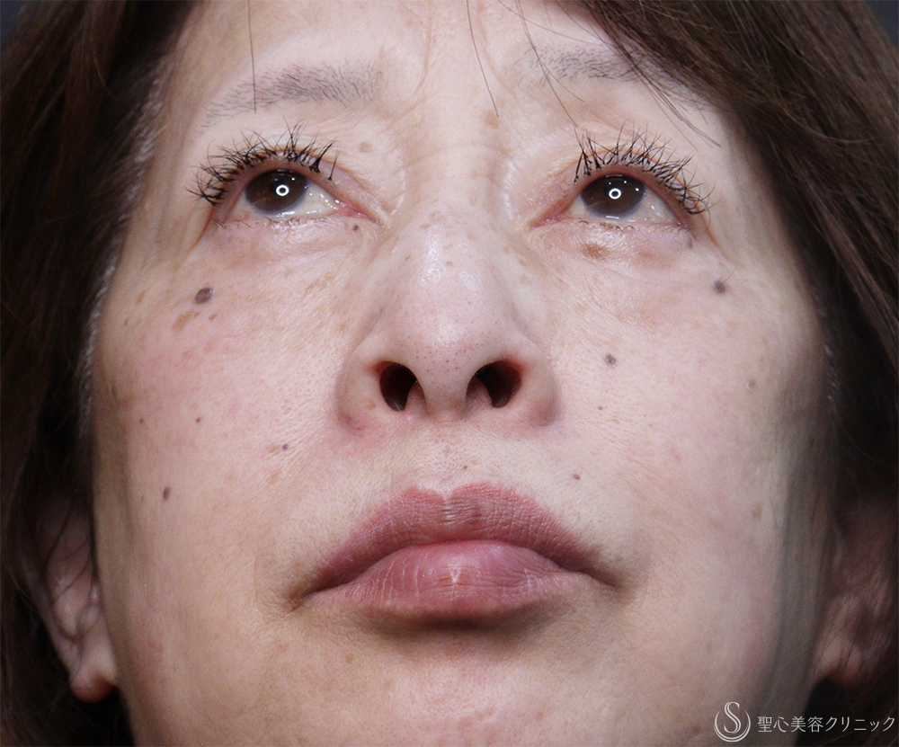 【60代女性・鼻孔を目立たなく】小鼻縮小（1ヶ月後） Before 