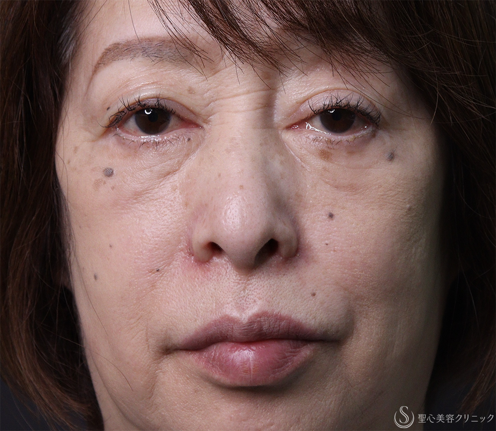 【60代女性・鼻孔を目立たなく】小鼻縮小（1ヶ月後） After 