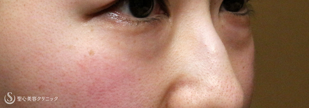 【20代女性・目の下のクマを脱脂だけで】経結膜下脱脂術 単独（直後〜1ヶ月後） Before 