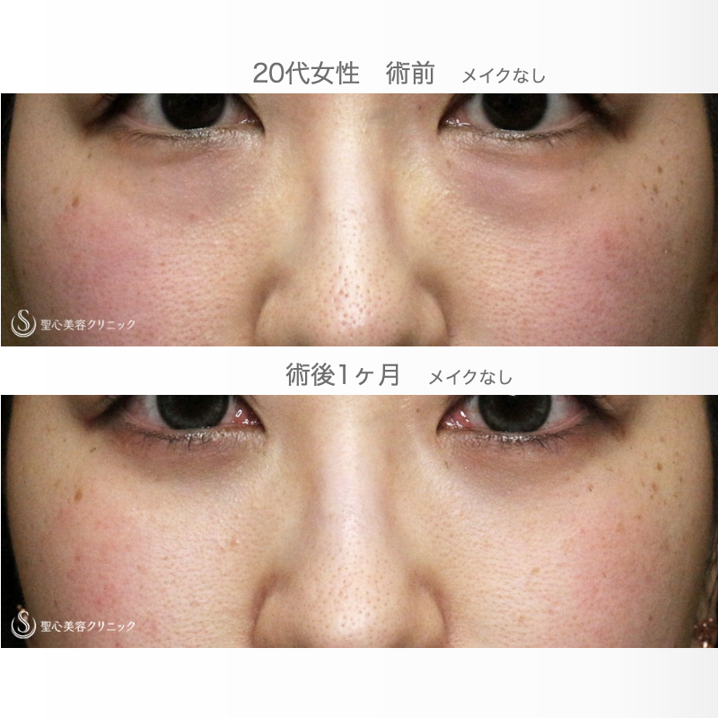 【20代女性・目の下のクマを脱脂だけで】経結膜下脱脂術 単独（直後〜1ヶ月後） After 