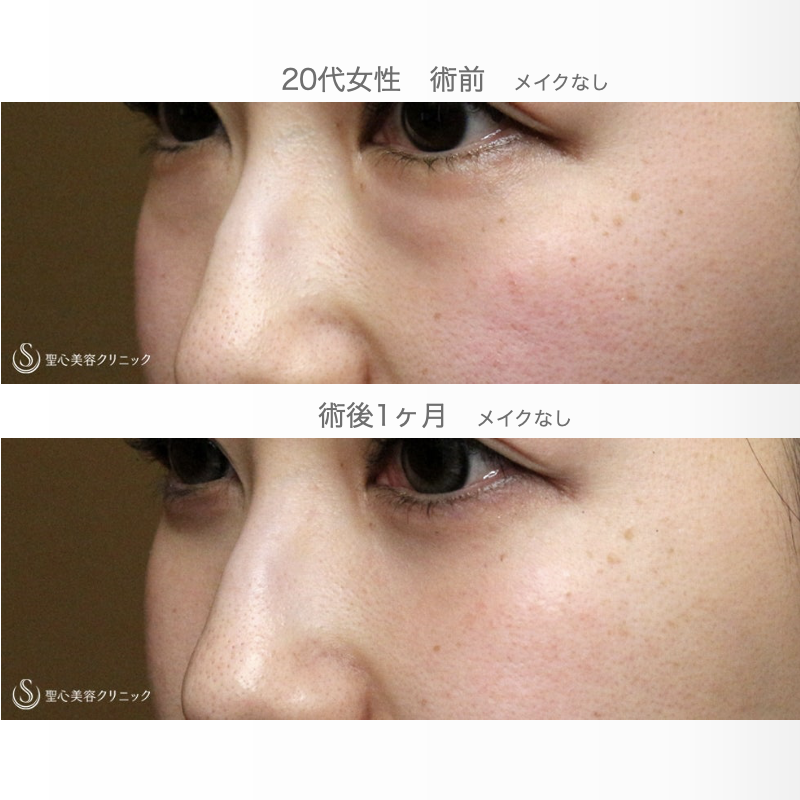 【20代女性・目の下のクマを脱脂だけで】経結膜下脱脂術 単独（直後〜1ヶ月後） After 