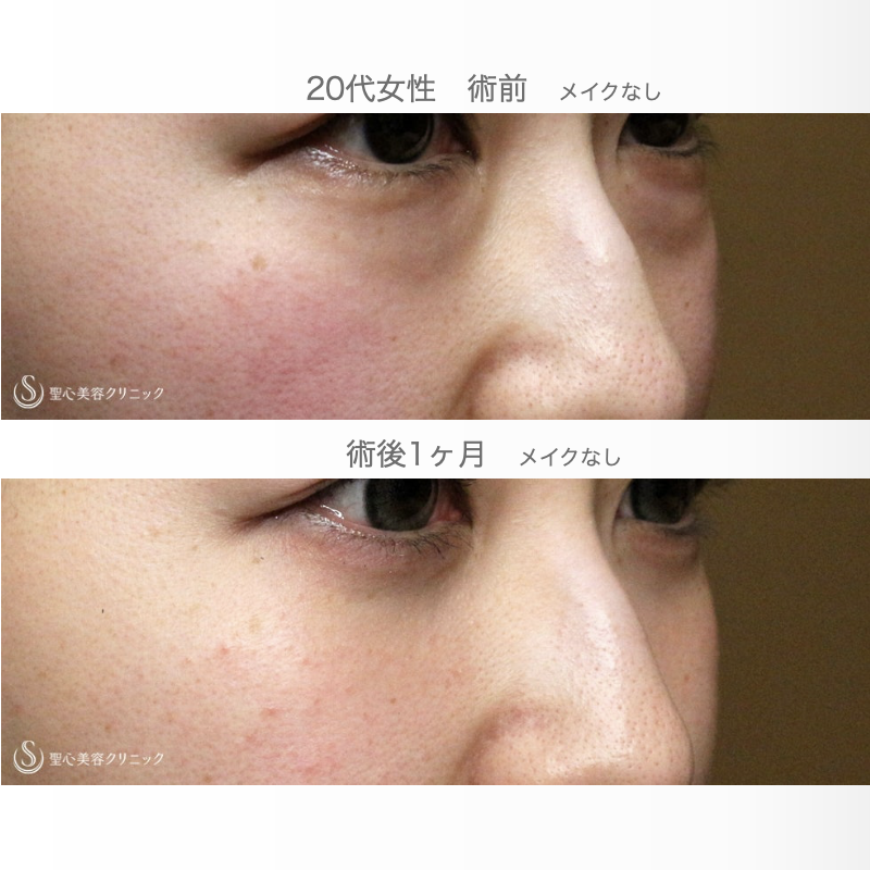 【20代女性・目の下のクマを脱脂だけで】経結膜下脱脂術 単独（直後〜1ヶ月後） After 