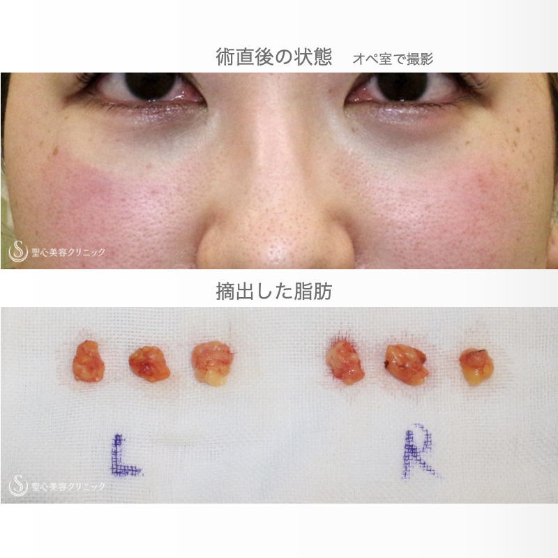 【20代女性・目の下のクマを脱脂だけで】経結膜下脱脂術 単独（直後〜1ヶ月後） Before 