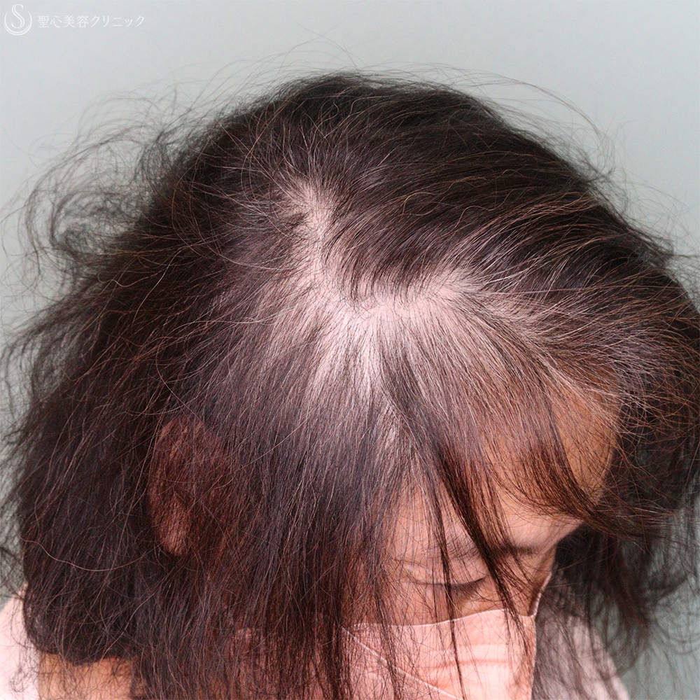 【60代女性・薄毛】EXOHAIR EVs（1ヶ月後） Before 