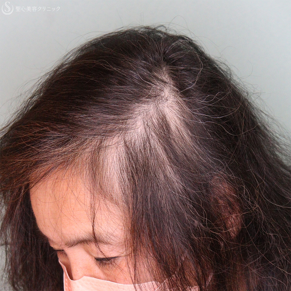【60代女性・薄毛】EXOHAIR EVs（1ヶ月後） Before 