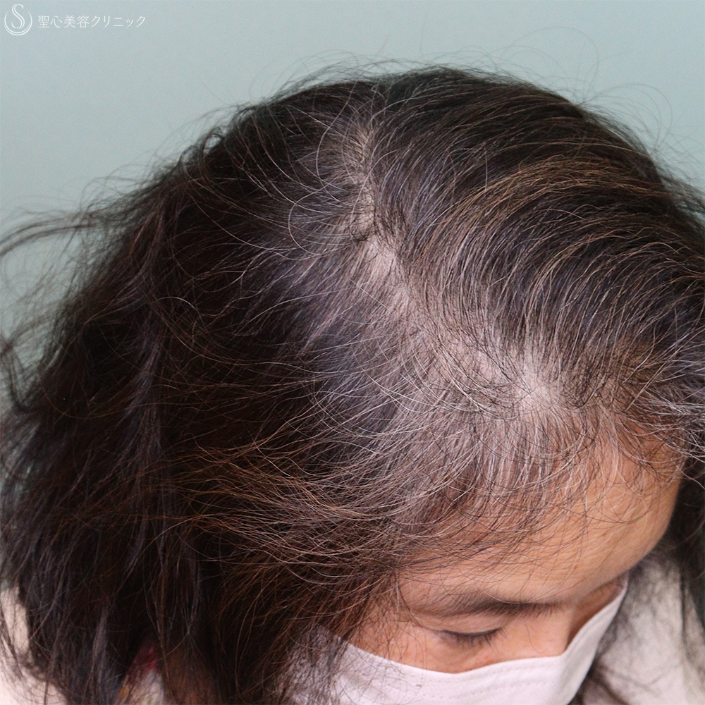 【60代女性・薄毛】EXOHAIR EVs（1ヶ月後） After 