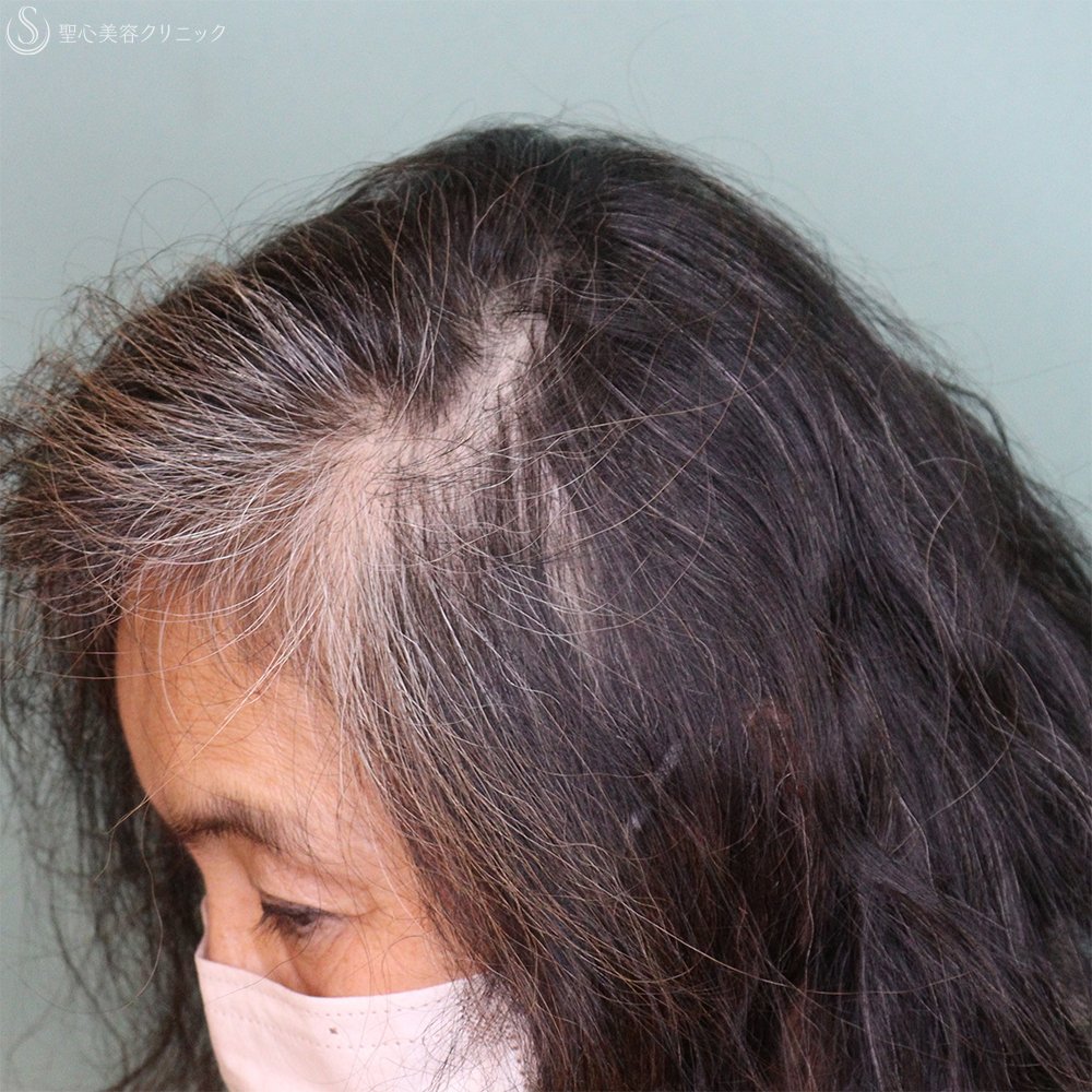 【60代女性・薄毛】EXOHAIR EVs（1ヶ月後） After 