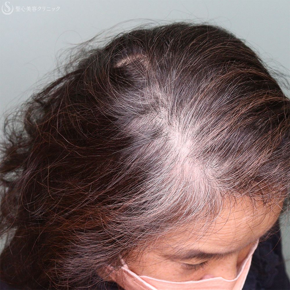 【60代女性・薄毛】EXOHAIR EVs（1ヶ月後） After 