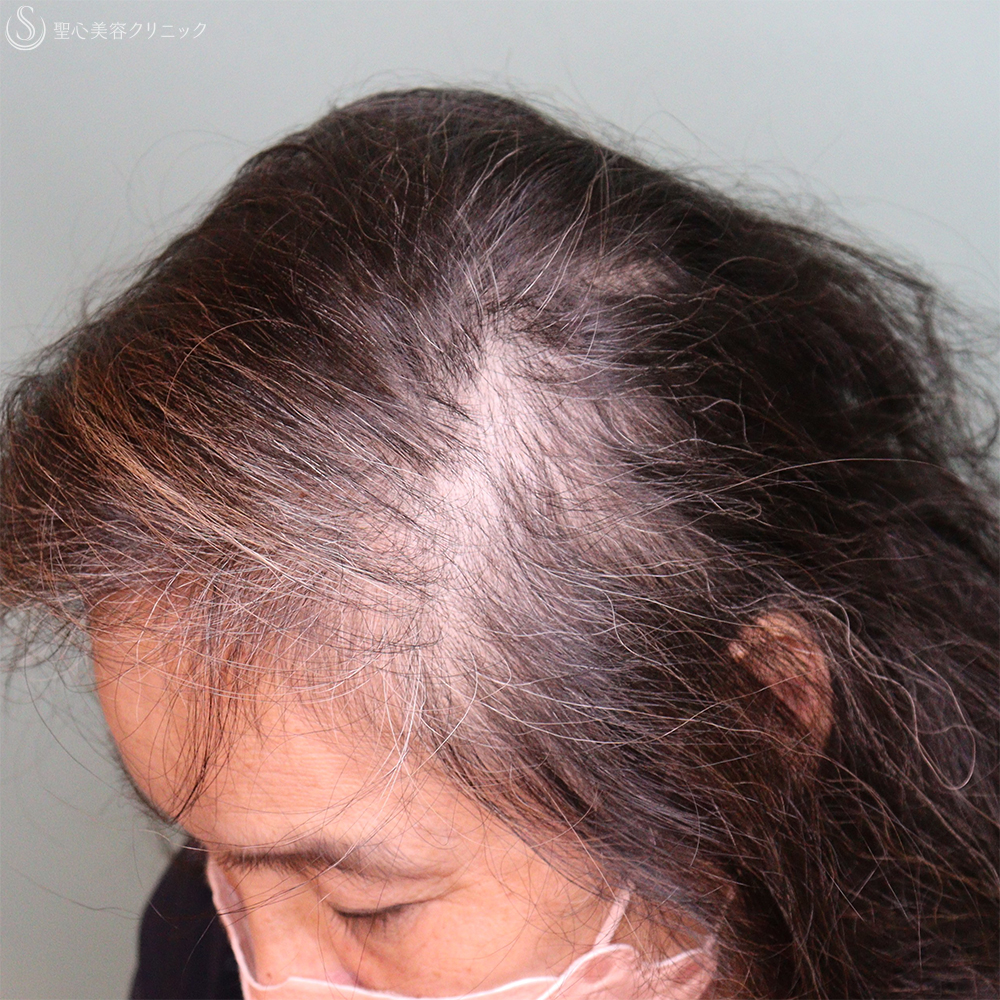 【60代女性・薄毛】EXOHAIR EVs（1ヶ月後） After 