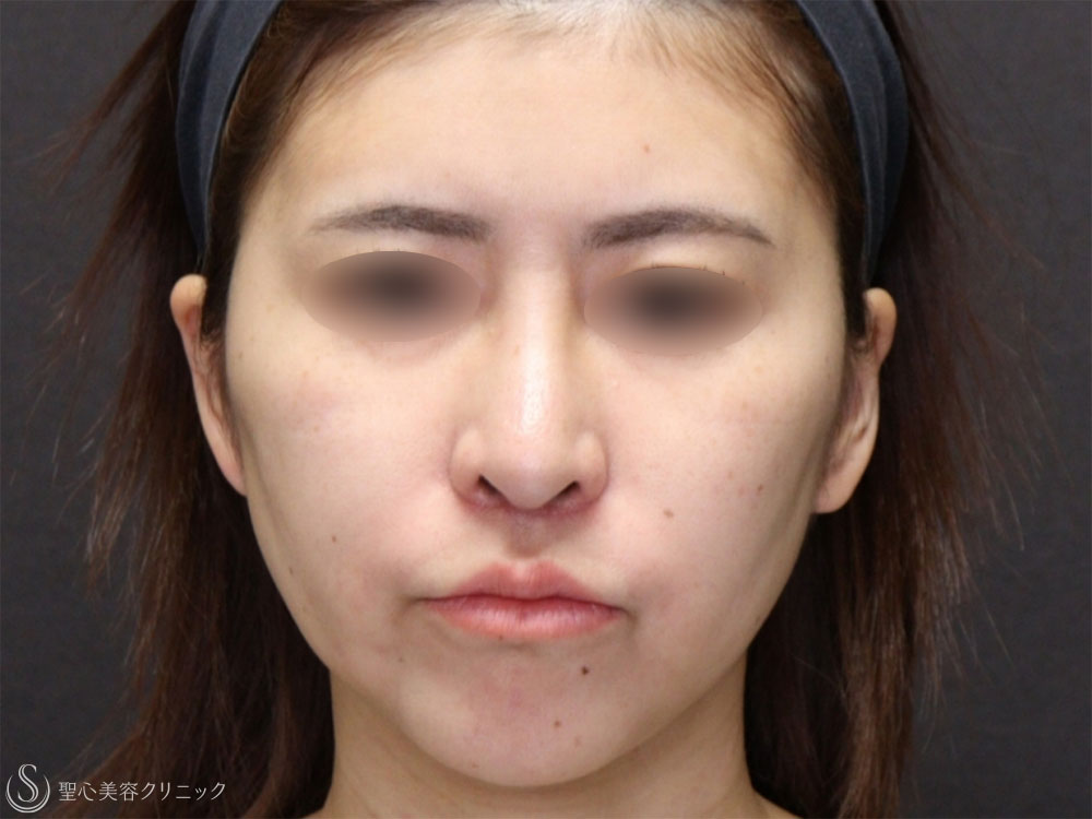 【30代女性・糸リフトで頬のたるみと顎下のたるみの改善】アンカーDXダブル（1ヶ月後） Before 