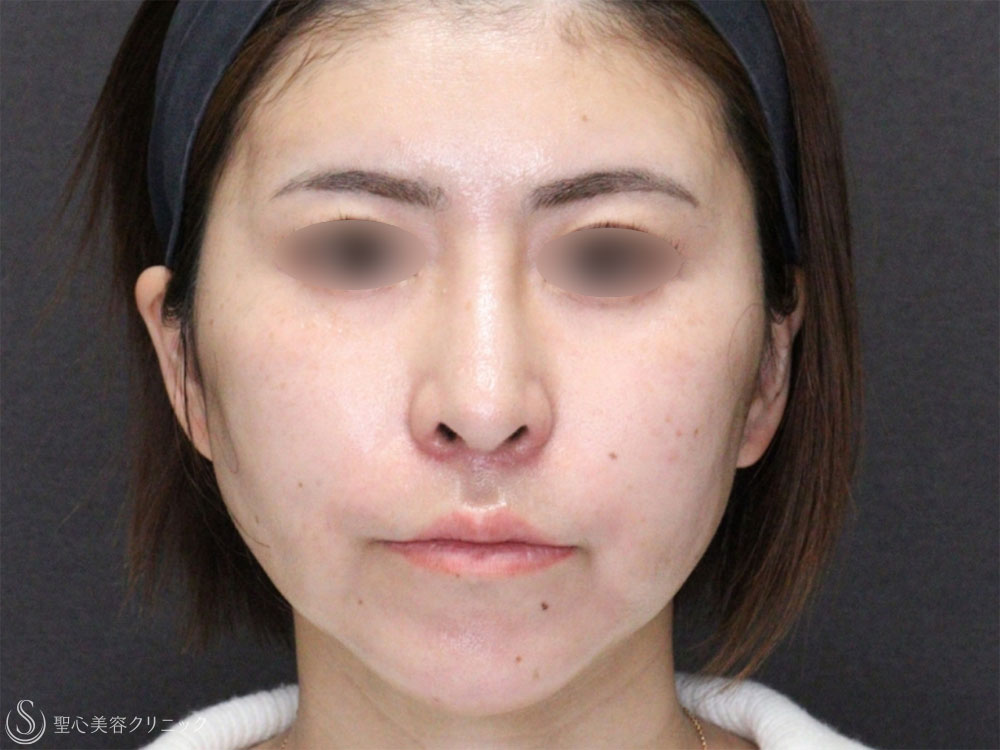 【30代女性・糸リフトで頬のたるみと顎下のたるみの改善】アンカーDXダブル（1ヶ月後） After 