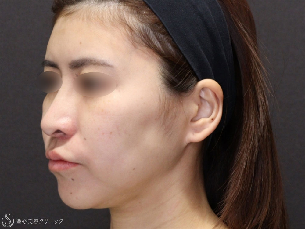 【30代女性・糸リフトで頬のたるみと顎下のたるみの改善】アンカーDXダブル（1ヶ月後） Before 