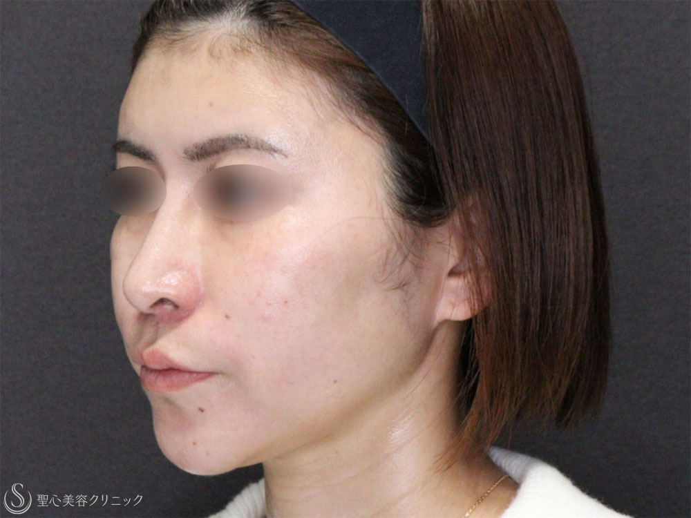 【30代女性・糸リフトで頬のたるみと顎下のたるみの改善】アンカーDXダブル（1ヶ月後） After 