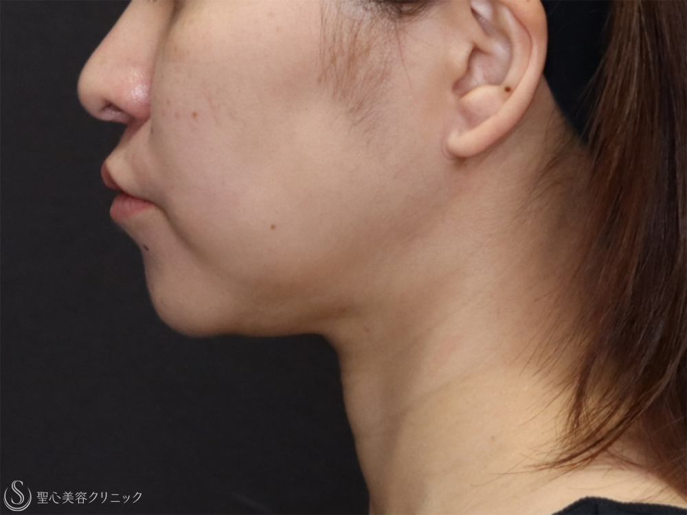 【30代女性・糸リフトで頬のたるみと顎下のたるみの改善】アンカーDXダブル（1ヶ月後） Before 