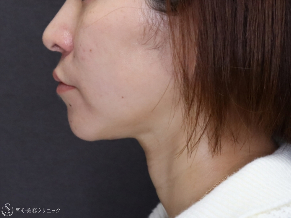 【30代女性・糸リフトで頬のたるみと顎下のたるみの改善】アンカーDXダブル（1ヶ月後） After 