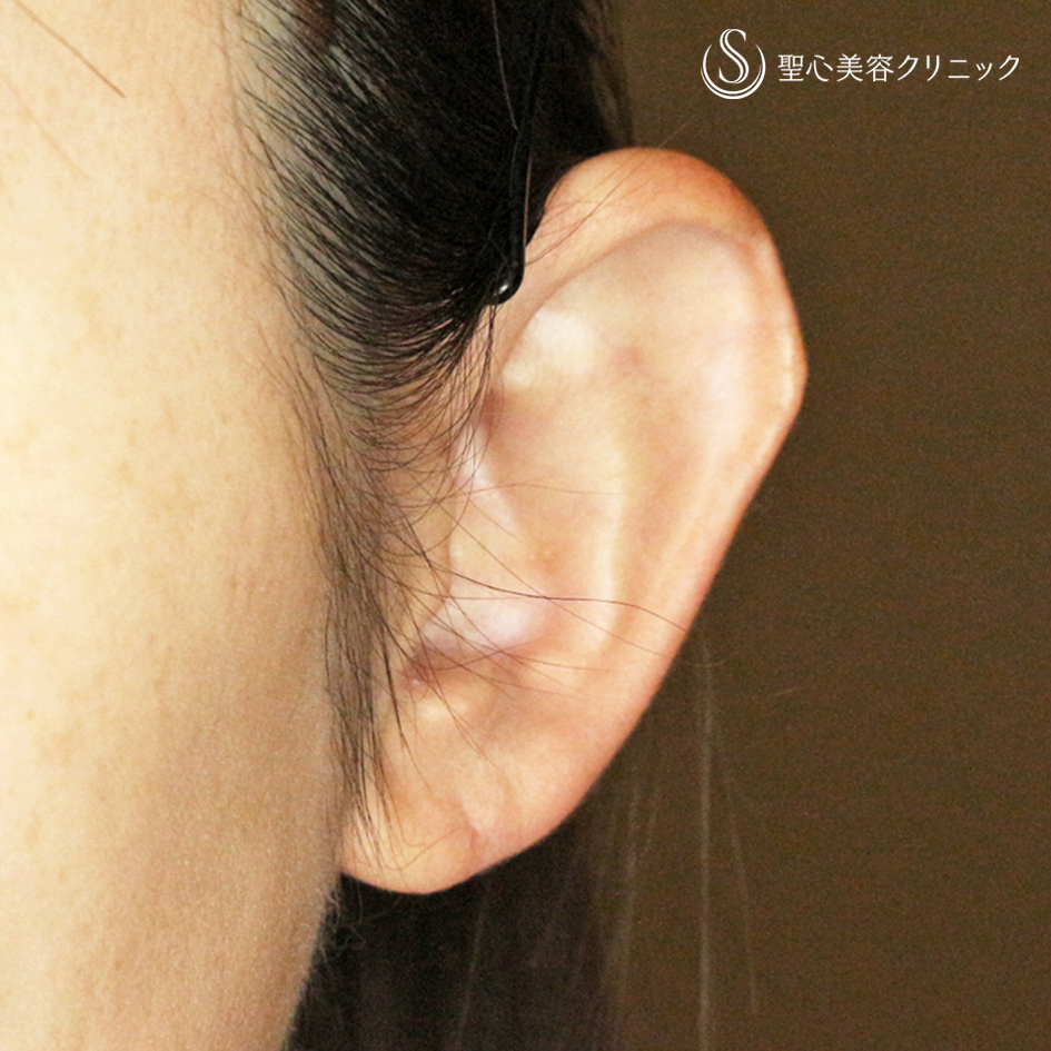 【30代女性・髪から耳が出ないように】立ち耳「埋没法」（直後〜1ヶ月後） Before 