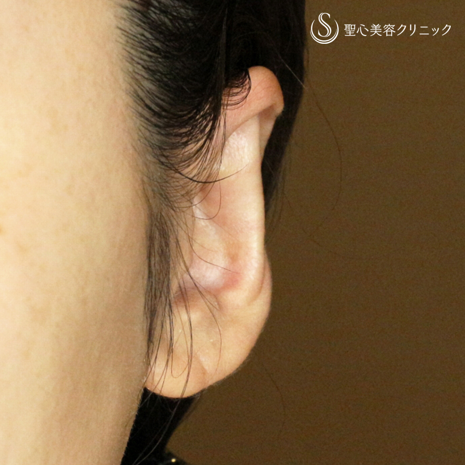 【30代女性・髪から耳が出ないように】立ち耳「埋没法」（直後〜1ヶ月後） After 