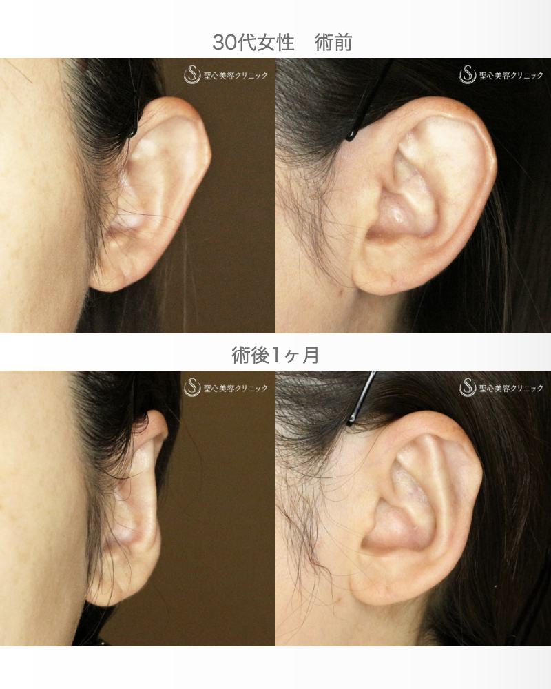 【30代女性・髪から耳が出ないように】立ち耳「埋没法」（直後〜1ヶ月後） After 