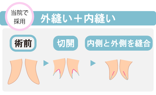 当院こだわりの術式「外縫い＋中縫い」