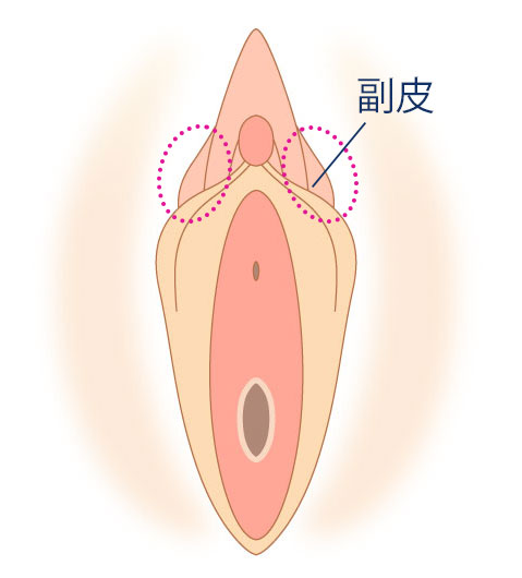 小陰唇縮小とは