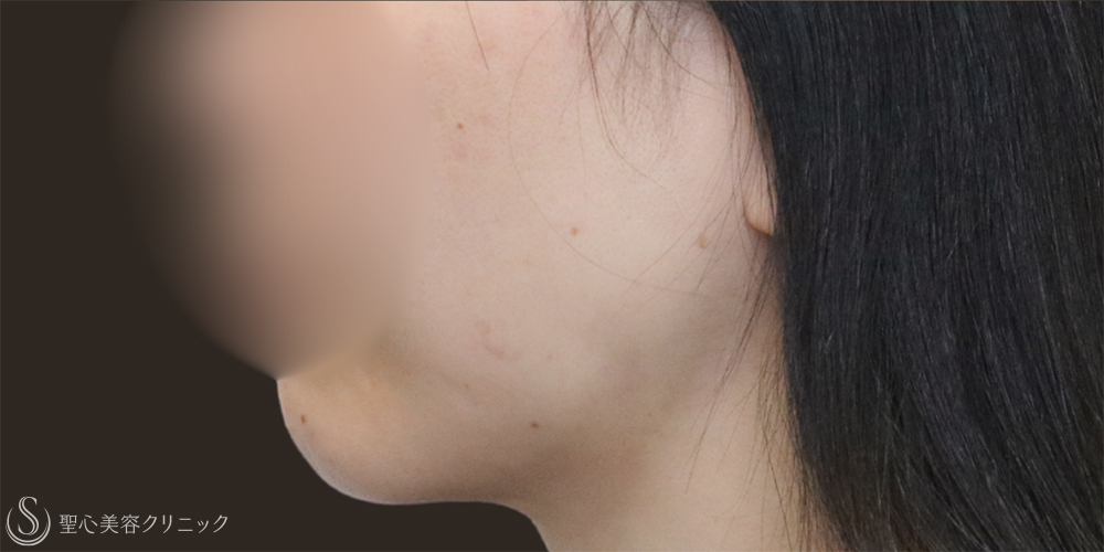 【30代女性・フェイスラインスッキリ】脂肪吸引（頬・顎下）（1ヶ月後） After 名古屋+たるみ　もたつき　アンチエイジング