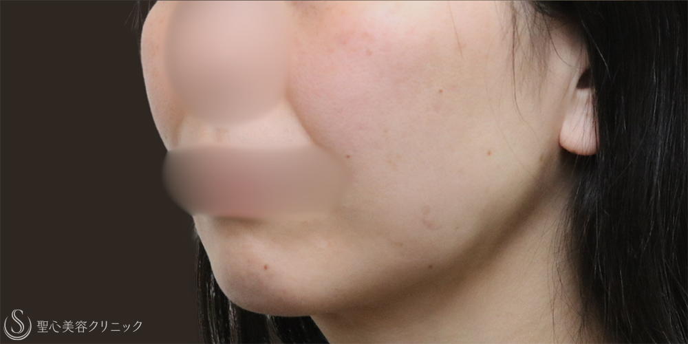 【30代女性・フェイスラインスッキリ】脂肪吸引（頬・顎下）（1ヶ月後） After 名古屋+たるみ　もたつき　アンチエイジング
