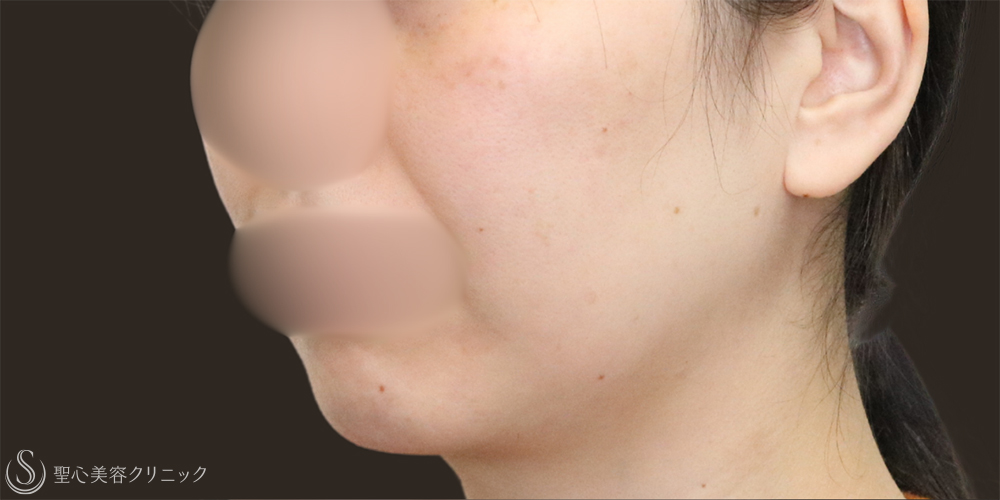 【30代女性・フェイスラインスッキリ】脂肪吸引（頬・顎下）（1ヶ月後） Before 名古屋+たるみ　もたつき　アンチエイジング