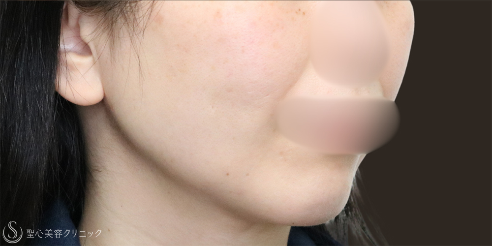 【30代女性・フェイスラインスッキリ】脂肪吸引（頬・顎下）（1ヶ月後） After 名古屋+たるみ　もたつき　アンチエイジング