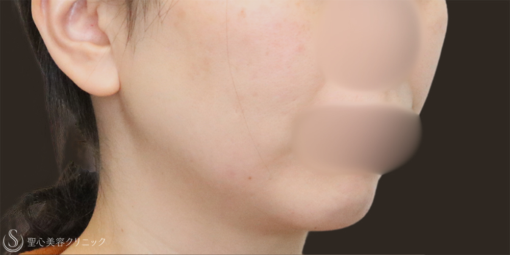 【30代女性・フェイスラインスッキリ】脂肪吸引（頬・顎下）（1ヶ月後） Before 名古屋+たるみ　もたつき　アンチエイジング