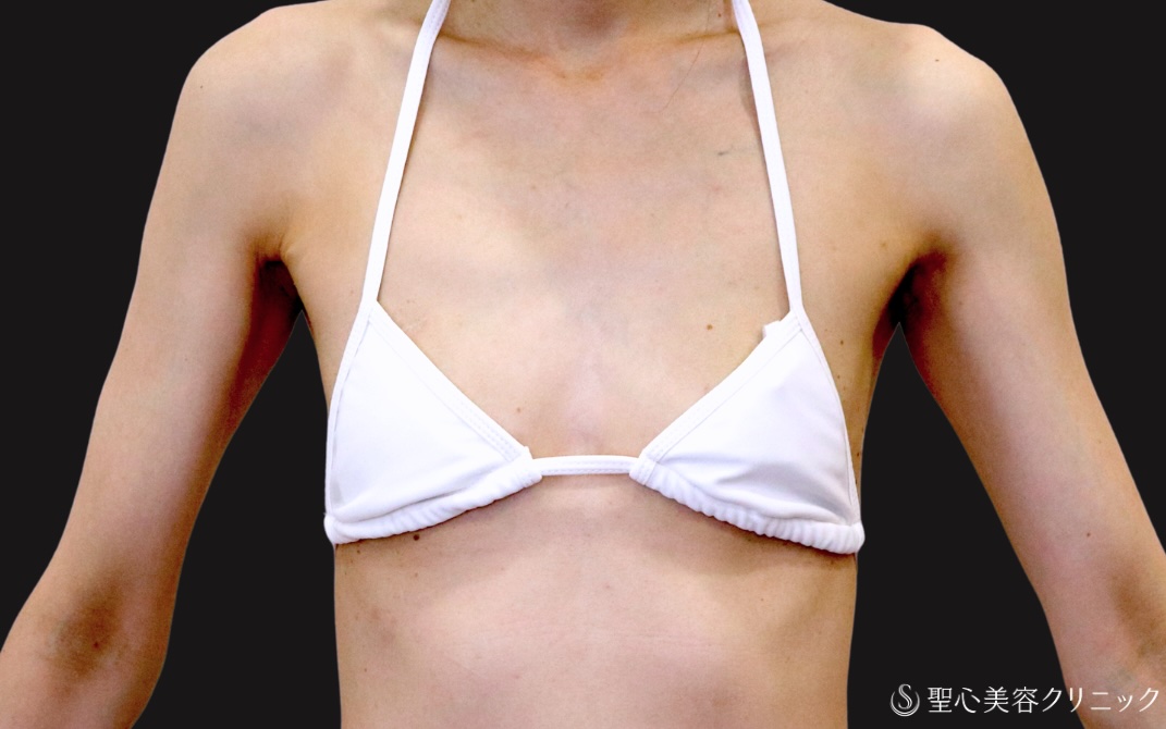 【40代女性・インプラント豊胸】Motiva  Demi 270cc（3ヶ月後） Before 