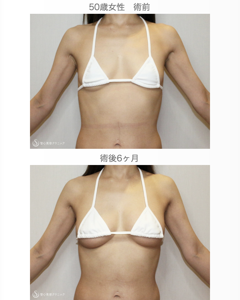 【50歳女性・柔らかく自然で綺麗なバスト】プレミアムセリューション豊胸術（6ヶ月後） After 