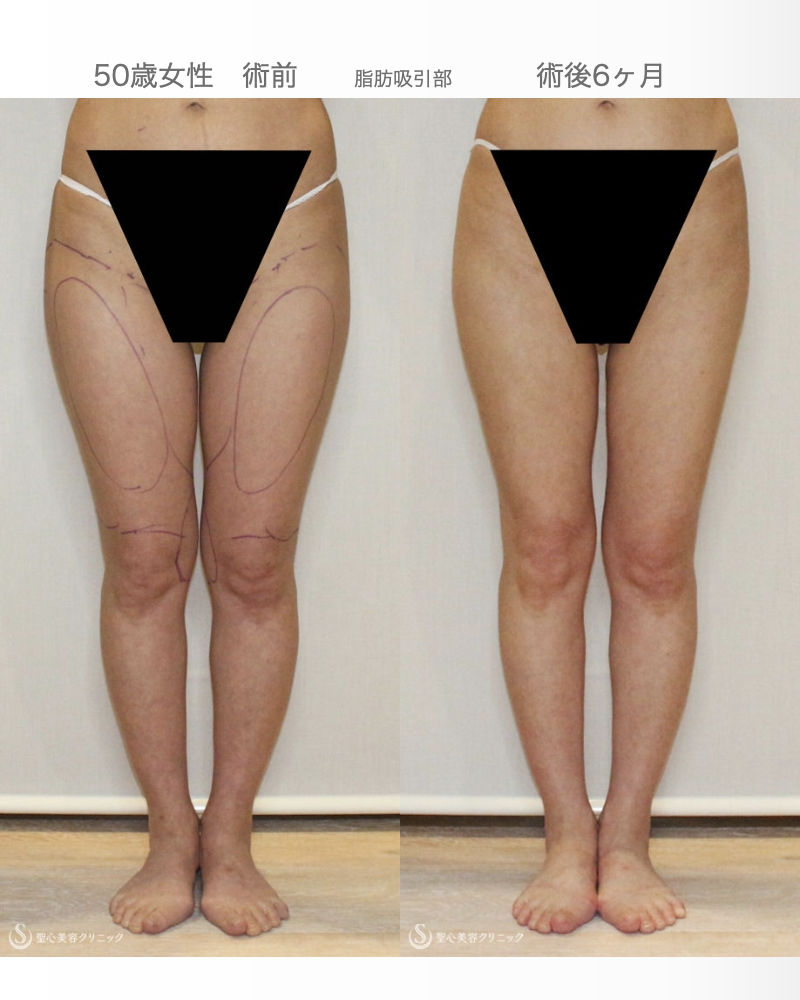 【50歳女性・柔らかく自然で綺麗なバスト】プレミアムセリューション豊胸術（6ヶ月後） After 