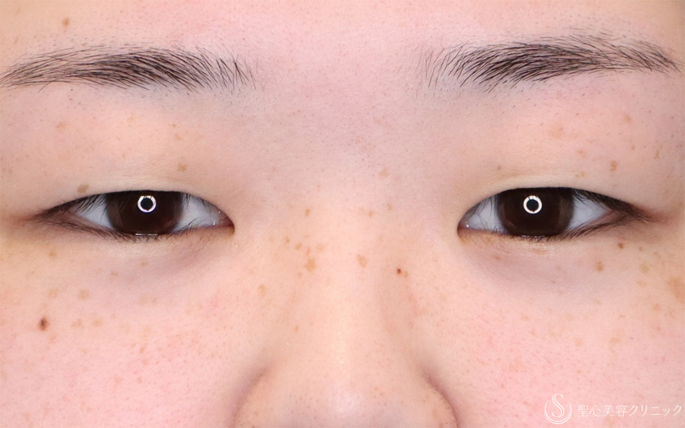 【20代女性・自然な二重に】二重埋没法：マイクロメソッド＋α（3点）（1ヶ月後） Before 
