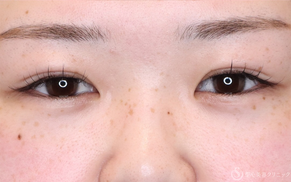 【20代女性・自然な二重に】二重埋没法：マイクロメソッド＋α（3点）（1ヶ月後） After 