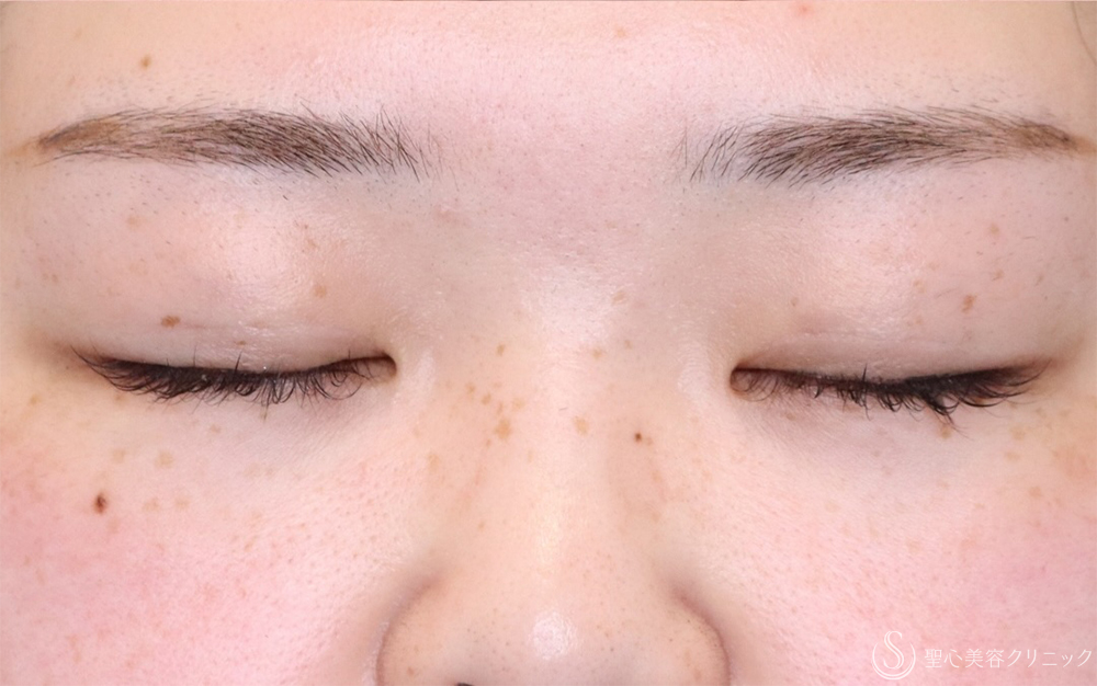 【20代女性・自然な二重に】二重埋没法：マイクロメソッド＋α（3点）（1ヶ月後） After 