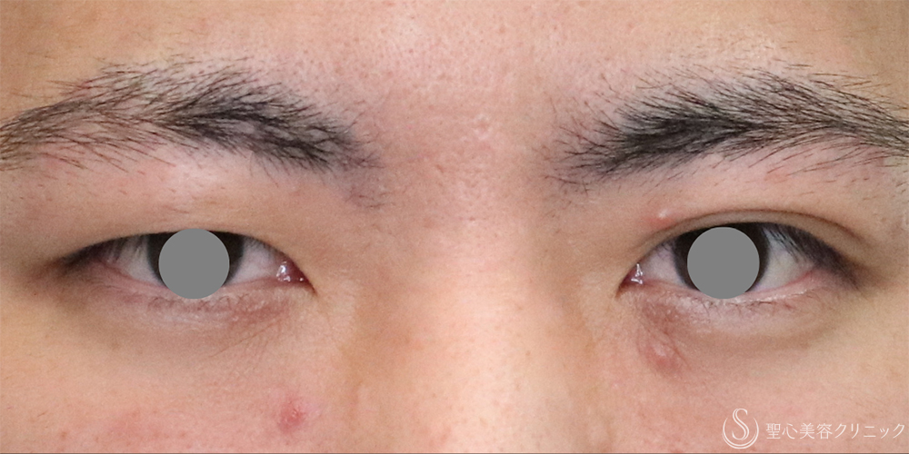【20代男性・左右差を整える】二重埋没法（マイクロメソッド+α）（1ヶ月後） Before 名古屋・二重整形