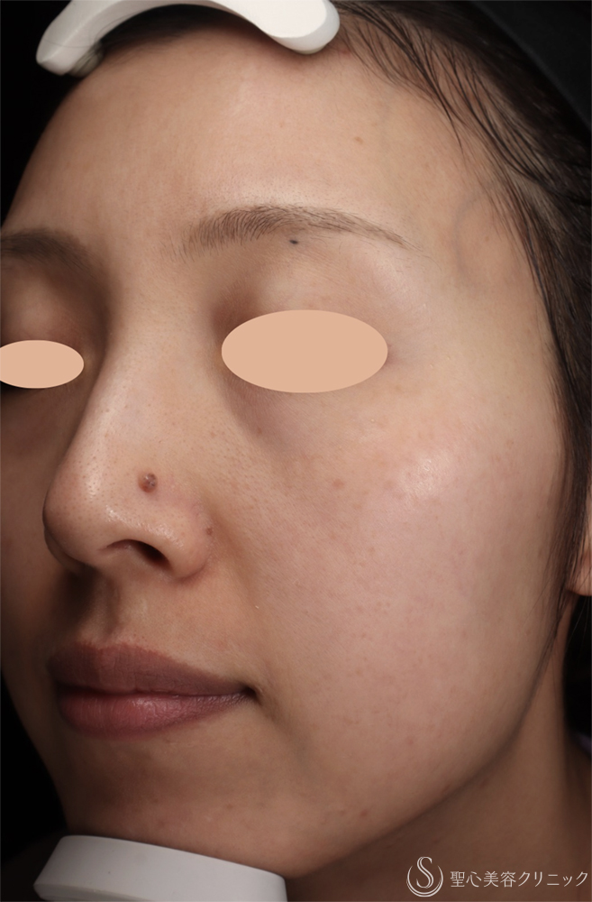 【30代女性・ADMのレーザー治療】Picosure pro®︎レーザー（7ヶ月後） After 