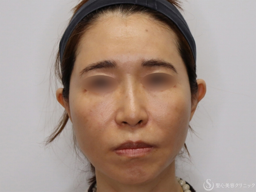 【50代女性・フェイスリフト並みの効果の糸リフト】アンカーDXダブル（1ヶ月後） After 