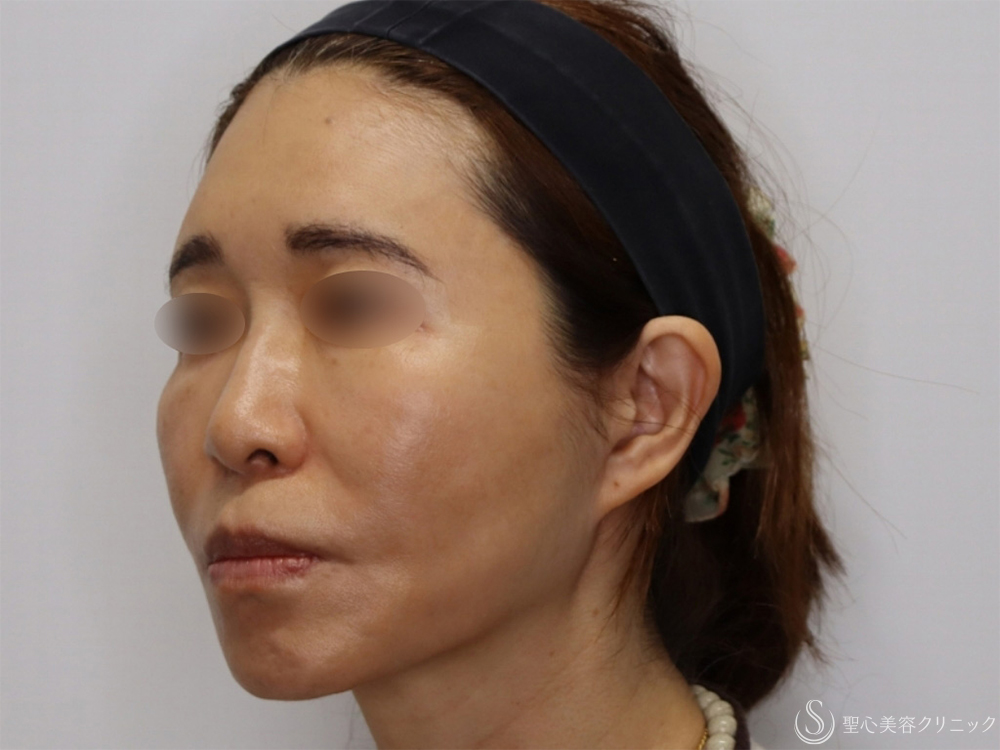【50代女性・フェイスリフト並みの効果の糸リフト】アンカーDXダブル（1ヶ月後） After 